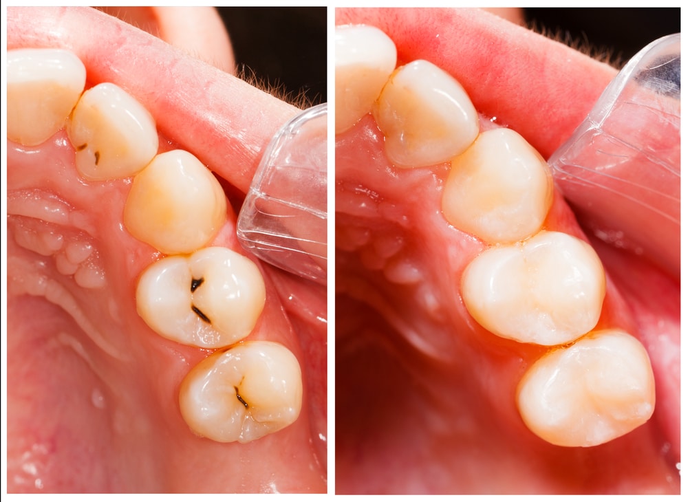 Dental-Tooth-Filling-Wilmington-North-Carolina